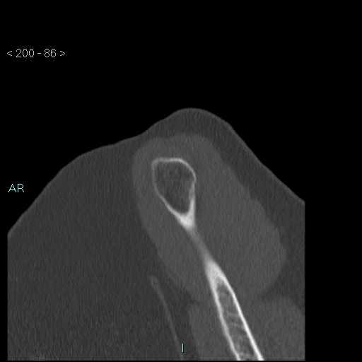 Avascular necrosis of the shoulder - Cruess stage I (Radiopaedia 77674-89887 Sagittal bone window 85).jpg