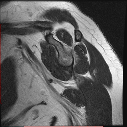File:Avulsion fracture - greater tuberosity of humerus (Radiopaedia 25457-25703 Sagittal T2 2).jpg