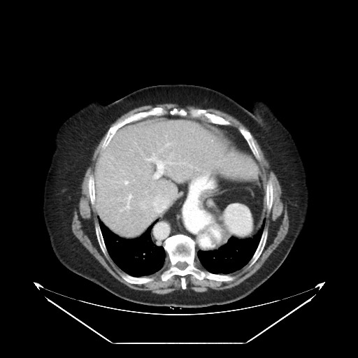 B-cell lymphoma of the mesentery (Radiopaedia 65711-74827 A 20).jpg