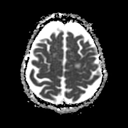 File:Balo concentric sclerosis (Radiopaedia 53875-59982 Axial ADC 20).jpg
