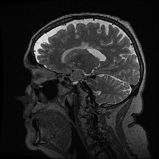 Balo concentric sclerosis (Radiopaedia 53875-59982 Sagittal 3D FSE 173).jpg