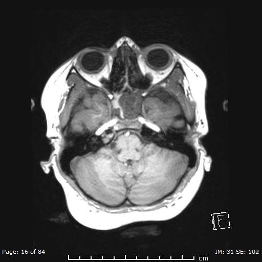 Balo concentric sclerosis (Radiopaedia 61637-69636 Axial T1 16).jpg