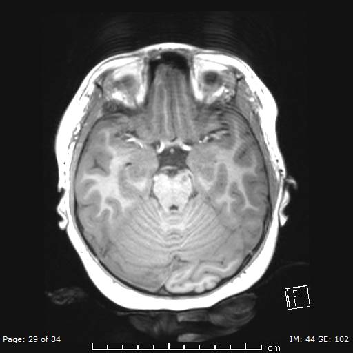 File:Balo concentric sclerosis (Radiopaedia 61637-69636 Axial T1 29).jpg