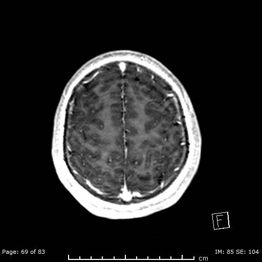 Balo concentric sclerosis (Radiopaedia 61637-69636 Axial T1 C+ 69).jpg
