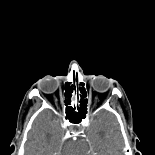 File:Basal cell carcinoma (periocular with orbital invasion) (Radiopaedia 30974-31672 Axial Postcontrast 18).jpg