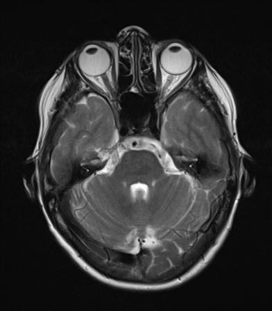 File:Base of skull chondrosarcoma (Radiopaedia 30410-31070 Axial T2 7).jpg