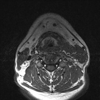 File:Base of tongue squamous cell carcinoma (Radiopaedia 31174-31884 Axial T1 10).jpg