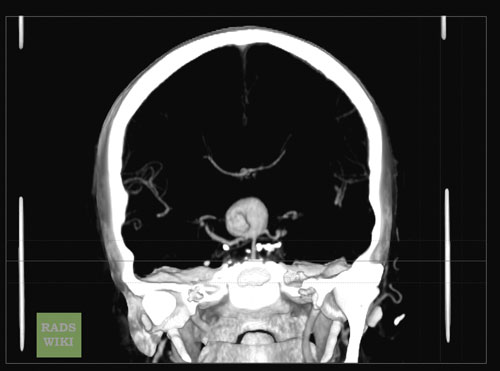 File:Basilar artery aneurysm (Radiopaedia 11533-11896 Coronal 1).jpg