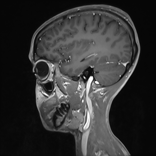 Basilar artery perforator aneurysm (Radiopaedia 82455-97733 G 108).jpg