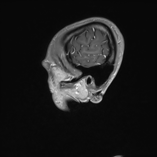 Basilar artery perforator aneurysm (Radiopaedia 82455-97733 G 17).jpg