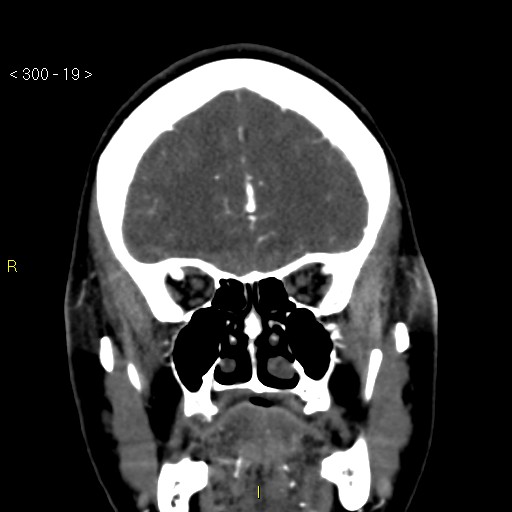 Basilar artery thrombosis (Radiopaedia 16260-15944 B 10).jpg