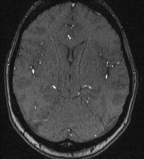 File:Basilar tip aneurysm (Radiopaedia 26504-26632 MRA 112).jpg