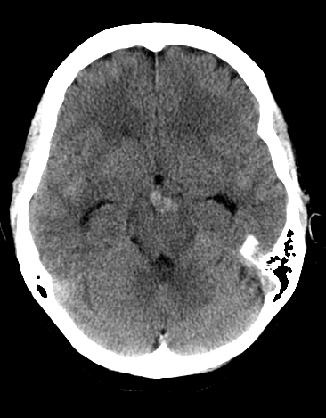 File:Basilar tip aneurysm with coiling (Radiopaedia 53912-60033 Axial non-contrast 10).jpg