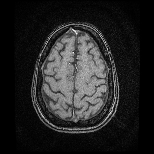 Basilar top and left middle cerebral artery aneurysm (Radiopaedia 61965-70031 Axial MRA 143).jpg