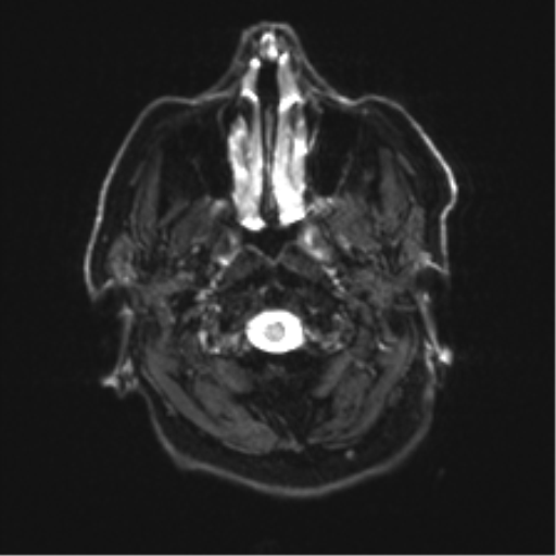 File:Behavioral variant frontotemporal dementia and late onset schizophrenia (Radiopaedia 52197-58083 Axial DTI Trace W 1).png