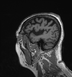 Behavioral variant frontotemporal dementia and late onset schizophrenia (Radiopaedia 52197-58083 Sagittal T1 90).png