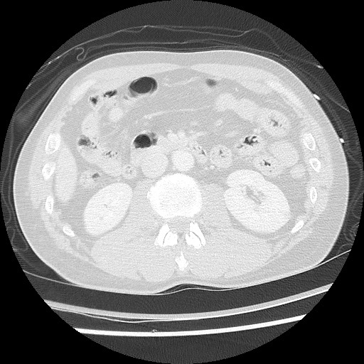 Benign post-traumatic pseudopneumoperitoneum (Radiopaedia 71199-81495 Axial lung window 85).jpg