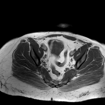 File:Benign seromucinous cystadenoma of the ovary (Radiopaedia 71065-81300 Axial T1 9).jpg