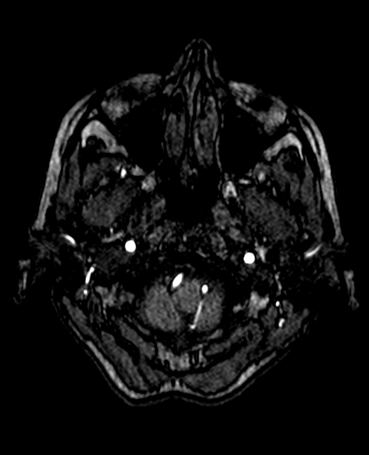 Berry aneurysm of the terminal internal carotid artery (Radiopaedia 88286-104918 Axial TOF 45).jpg