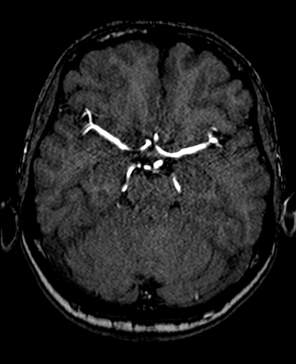 File:Berry aneurysm of the terminal internal carotid artery (Radiopaedia 88286-104918 Axial TOF 99).jpg