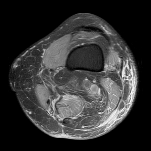 File:Biceps femoris distal tendon avulsion (Radiopaedia 15109-14987 Axial PD fat sat 1).jpg