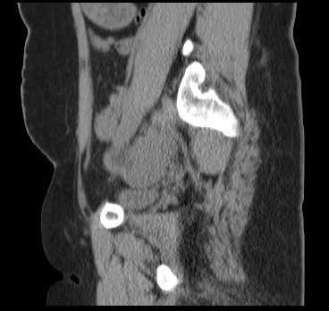 File:Bicornuate uterus (MRI) (Radiopaedia 49206-54296 Sagittal 13).png