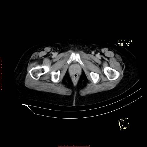 File:Bifid ureter (Radiopaedia 47604-52253 Axial C+ delayed 32).jpg