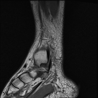 File:Bilateral Achilles tendon complete tear (Radiopaedia 81344-95051 Sagittal T1 15).jpg