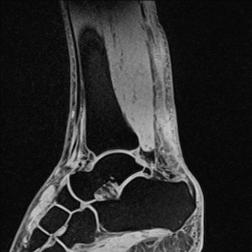 File:Bilateral Achilles tendon complete tear (Radiopaedia 81344-95051 Sagittal WE - Left 67).jpg