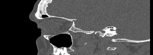 Bilateral Ectopic Infraorbital Nerves (Radiopaedia 49006-54084 Sagittal bone window 41).jpg
