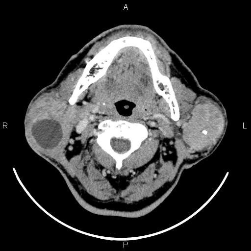 File:Bilateral Warthin tumors (Radiopaedia 84034-99263 Axial With contrast 26).jpg