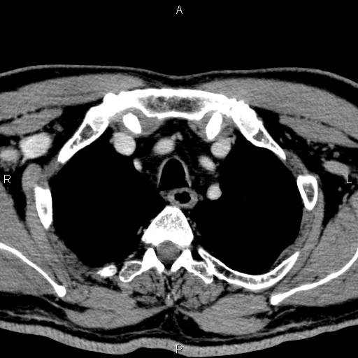 Bilateral Warthin tumors (Radiopaedia 84034-99263 Axial With contrast 69).jpg