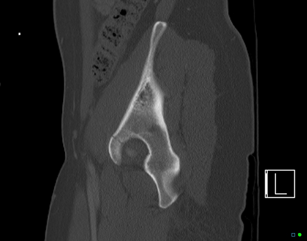 Bilateral acetabular fractures (Radiopaedia 79272-92308 Sagittal bone window 23).jpg