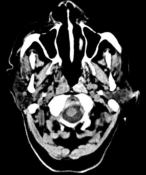 Bilateral acute on chronic subdural hematomas (Radiopaedia 78466-91146 Axial non-contrast 9).jpg