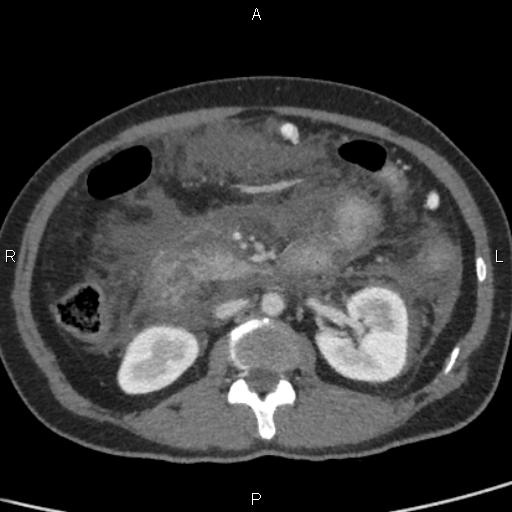 Bilateral adrenal gland hyperenhancement in pancreatitis (Radiopaedia 86642-102753 E 50).jpg