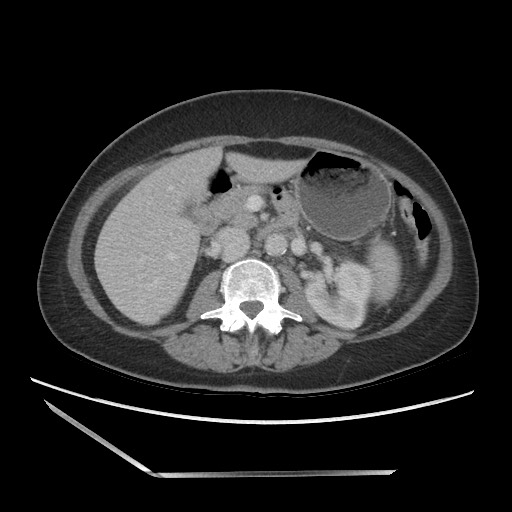 Bilateral adrenal granulocytic sarcomas (chloromas) (Radiopaedia 78375-91007 A 51).jpg