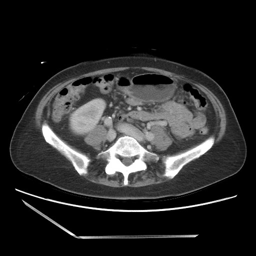 File:Bilateral adrenal granulocytic sarcomas (chloromas) (Radiopaedia 78375-91007 Axial 10).jpg