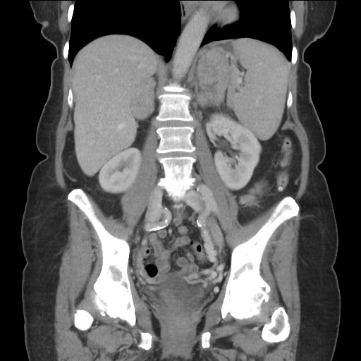 Bilateral adrenal granulocytic sarcomas (chloromas) (Radiopaedia 78375-91007 B 56).jpg