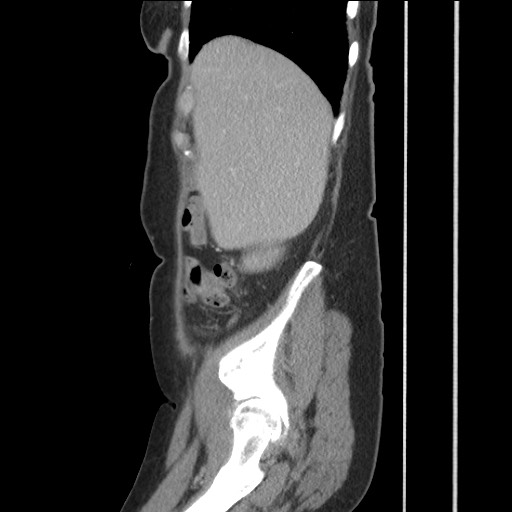 Bilateral adrenal granulocytic sarcomas (chloromas) (Radiopaedia 78375-91007 C 37).jpg