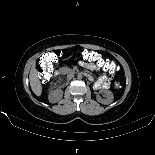 Bilateral adrenal myelolipoma (Radiopaedia 63058-71535 Axial non-contrast 71).jpg