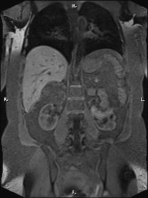 File:Bilateral adrenal myelolipoma (Radiopaedia 63058-71537 Coronal T1 fat sat 43).jpg