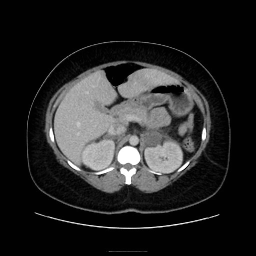 Bilateral adrenal thrombosis (Radiopaedia 58182-65256 A 22).jpg