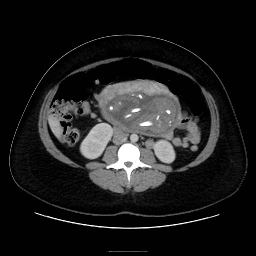 Bilateral adrenal thrombosis (Radiopaedia 58182-65256 A 38).jpg