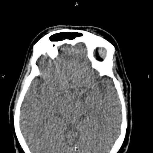 Bilateral enlargement of lacrimal glands - sarcoidosis (Radiopaedia 62627-70921 Axial non-contrast 66).jpg
