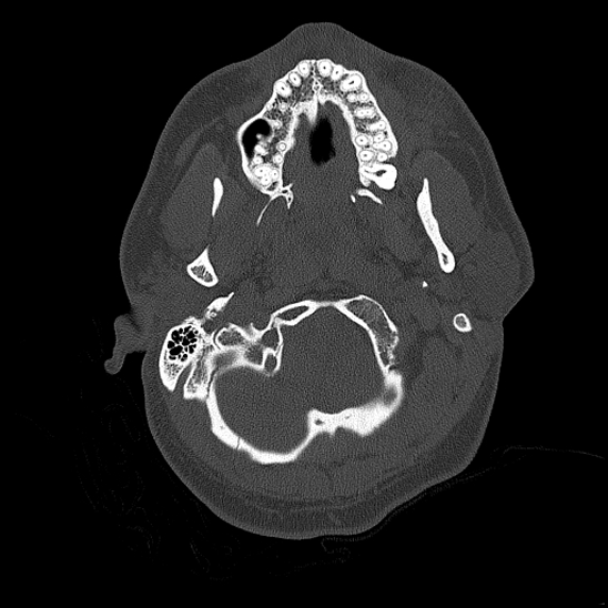 Bilateral occipital condyle fracture (type 2) (Radiopaedia 87675-104089 Axial bone thins 20).jpg