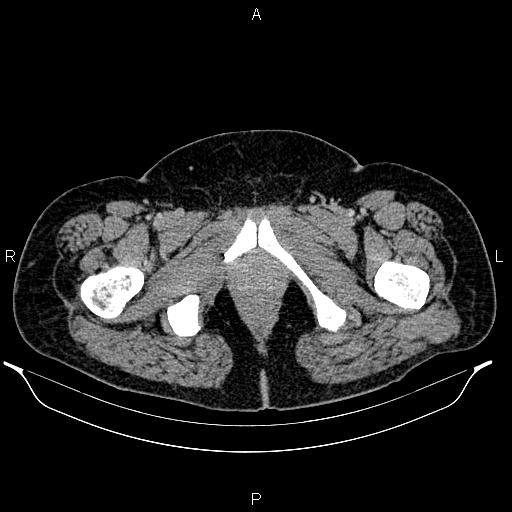 Bilateral ovarian dermoid cysts (Radiopaedia 85785-101603 A 113).jpg