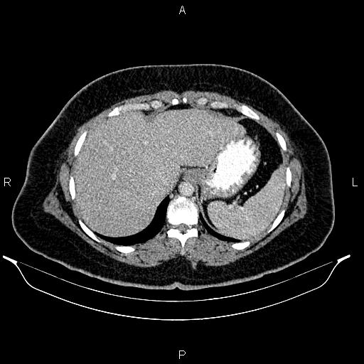 Bilateral ovarian dermoid cysts (Radiopaedia 85785-101603 A 21).jpg