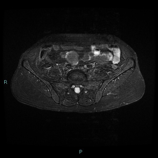File:Bilateral ovarian fibroma (Radiopaedia 44568-48293 Axial STIR 3).jpg