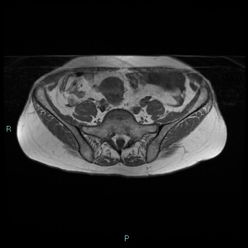 File:Bilateral ovarian fibroma (Radiopaedia 44568-48293 Axial T1 4).jpg