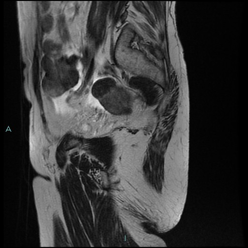 File:Bilateral ovarian fibroma (Radiopaedia 44568-48293 Sagittal T2 26).jpg